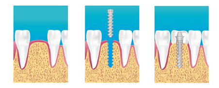 implant dentaire paris 17