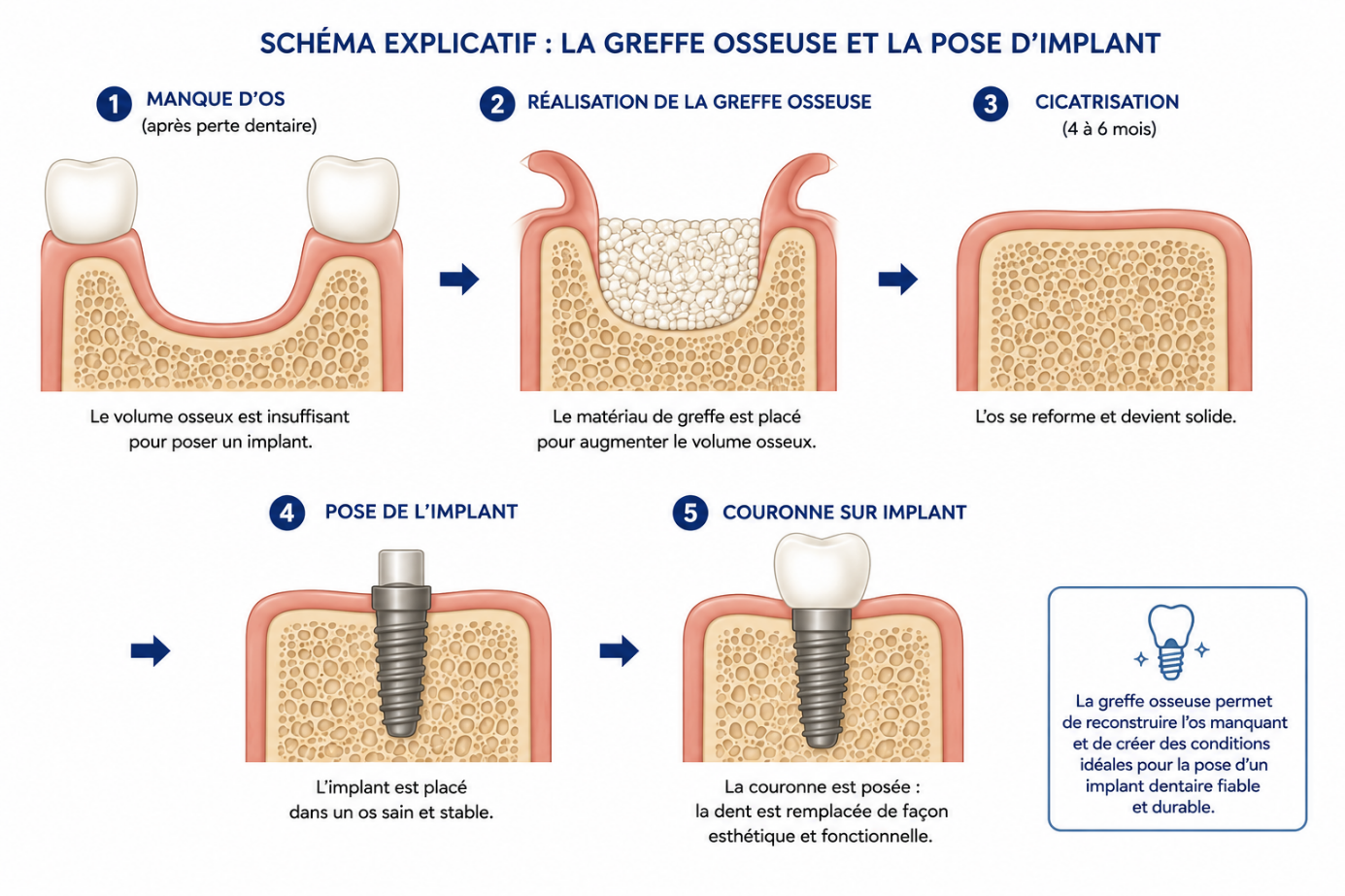 Implants dentaires
