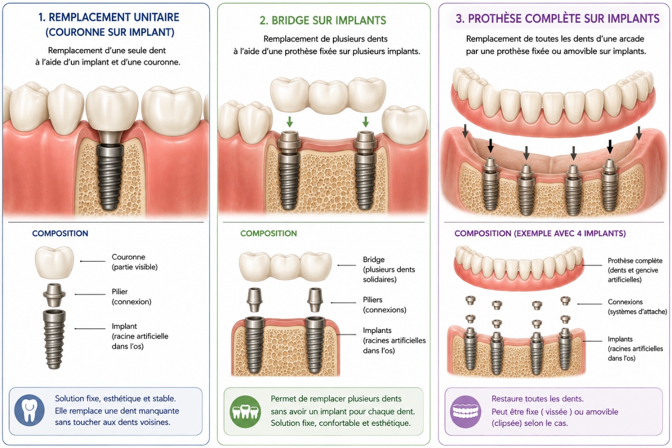 Implants dentaires